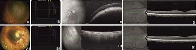 Long-Term Outcomes in Uveal Melanoma After Ruthenium-106 Brachytherapy